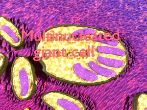 3D Caseating granuolma tuberculosis labelled model 3D Model