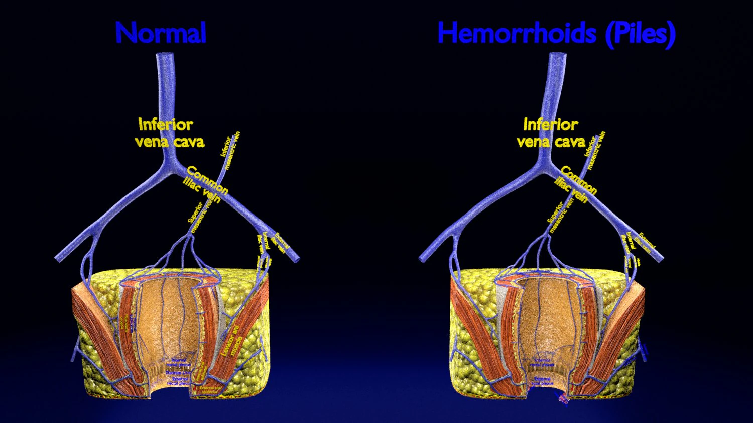 3D hemorrhoids CLEANED UP model 3D Model .c4d .max .obj .3ds .fbx .stl .blend 