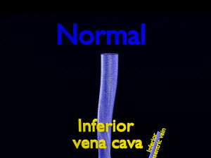 3D hemorrhoids CLEANED UP model 3D-Modell
