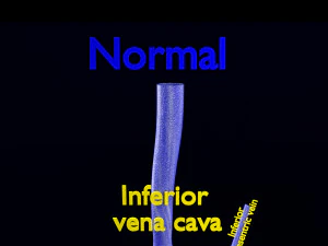 3D hemorrhoids CLEANED UP model 3D Model