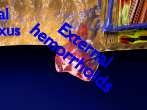 3D hemorrhoids CLEANED UP model 3D-Modell