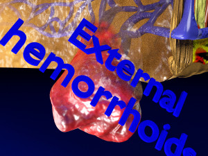 3D hemorrhoids CLEANED UP model 3D-Modell