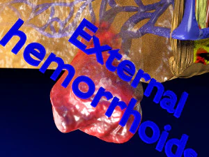 3D hemorrhoids CLEANED UP model 3D Model