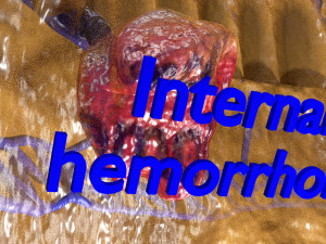 3D hemorrhoids CLEANED UP model 3D-Modell
