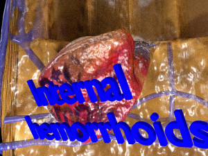 3D hemorrhoids CLEANED UP model 3D-Modell