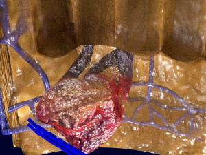3D hemorrhoids CLEANED UP model 3D-Modell
