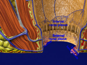 3D hemorrhoids CLEANED UP model 3D-Modell