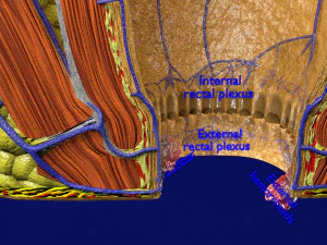3D hemorrhoids CLEANED UP model 3D Model