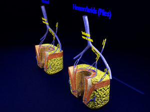 3D hemorrhoids CLEANED UP model 3D-Modell