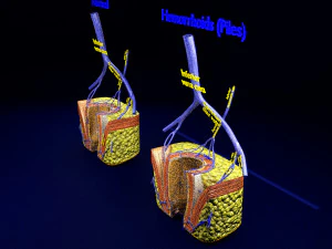 3D hemorrhoids CLEANED UP model 3D Model
