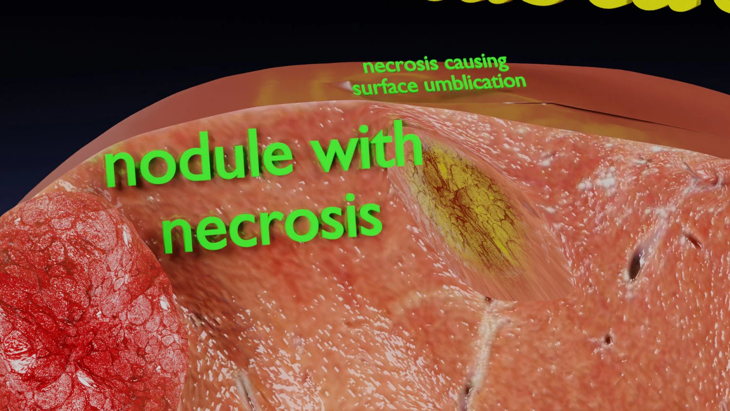 3D Liver cancer HCC vs Metastatic 3D Model .c4d .max .obj .3ds .fbx .stl .blend 