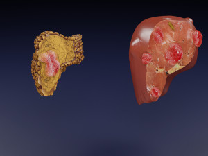 3D Liver cancer HCC vs Metastatic 3D Model