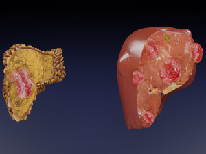 3D Liver cancer HCC vs Metastatic 3D Model