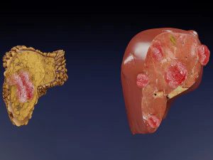 3D Liver cancer HCC vs Metastatic 3D Model