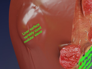 3D Liver cancer HCC vs Metastatic 3D Model