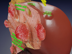 3D Liver cancer HCC vs Metastatic 3D Model