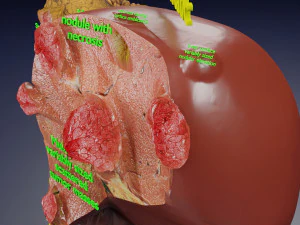 3D Liver cancer HCC vs Metastatic 3D Model