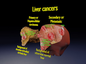 3D Liver cancer HCC vs Metastatic 3D Model