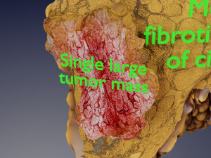 3D Liver cancer HCC vs Metastatic 3D Model