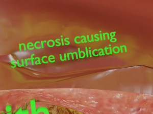 3D Liver cancer HCC vs Metastatic 3D Model