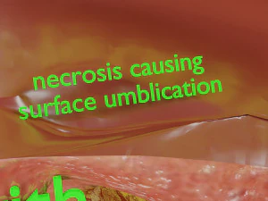 3D Liver cancer HCC vs Metastatic 3D Model