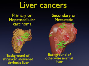 3D Liver cancer HCC vs Metastatic 3D Model