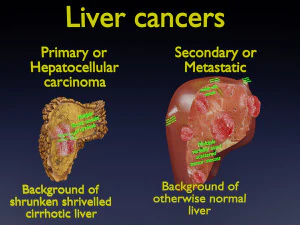 3D Liver cancer HCC vs Metastatic 3D Model