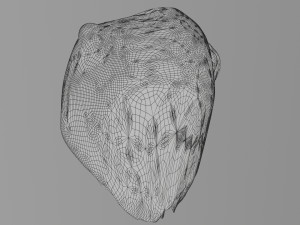 3D Liver cancer HCC vs Metastatic 3D Model