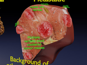 3D Liver cancer HCC vs Metastatic 3D Model