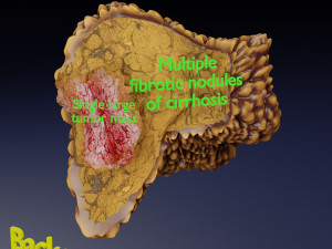 3D Liver cancer HCC vs Metastatic 3D Model