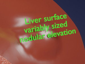 3D Liver cancer HCC vs Metastatic 3D Model