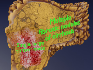 3D Liver cancer HCC vs Metastatic 3D Model