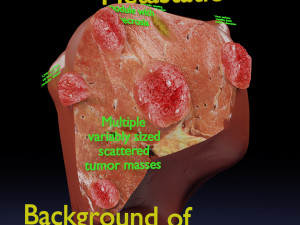 3D Liver cancer HCC vs Metastatic 3D Model