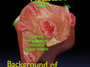 3D Liver cancer HCC vs Metastatic 3D Model