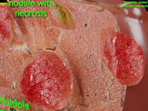 3D Liver cancer HCC vs Metastatic 3D Model