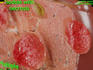 3D Liver cancer HCC vs Metastatic 3D Model