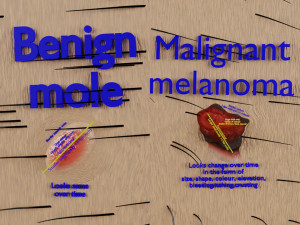 Mole nevus cancer Malignant melanoma differences 3D 3D Model