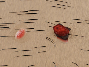 Mole nevus cancer Malignant melanoma differences 3D Modelo 3D
