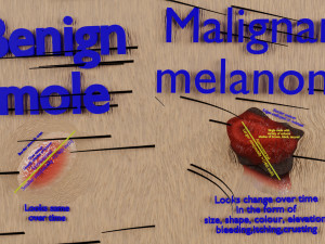 Mole nevus cancer Malignant melanoma differences 3D Modelo 3D