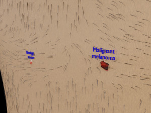 Mole nevus cancer Malignant melanoma differences 3D Modelo 3D