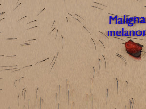 Mole nevus cancer Malignant melanoma differences 3D Modelo 3D