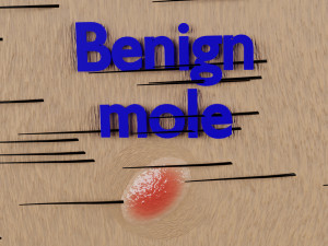 Mole nevus cancer Malignant melanoma differences 3D Modelo 3D