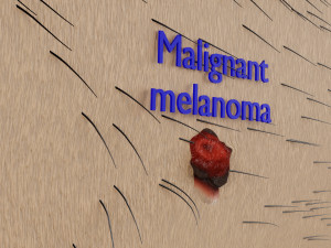 Mole nevus cancer Malignant melanoma differences 3D Modelo 3D