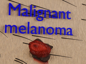 Mole nevus cancer Malignant melanoma differences 3D Modelo 3D