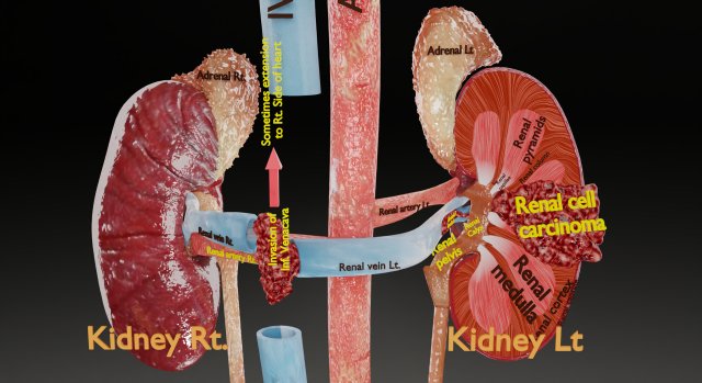 Renal cell carcinoma 3D Модель .c4d .max .obj .3ds .fbx .stl .blend 