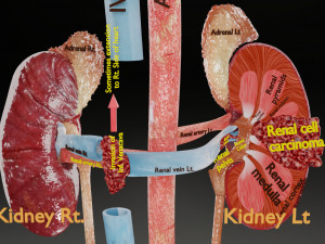 Renal cell carcinoma 3D Model