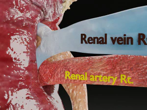 Renal cell carcinoma 3D Model