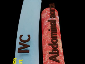 Renal cell carcinoma 3D Model