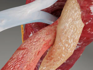 Renal cell carcinoma 3D Model