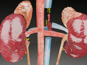 Renal cell carcinoma 3D Model